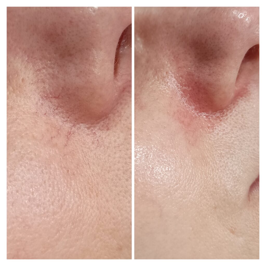 Zamykanie Naczynek  Znamion Rubinowych Bydgoszcz 07